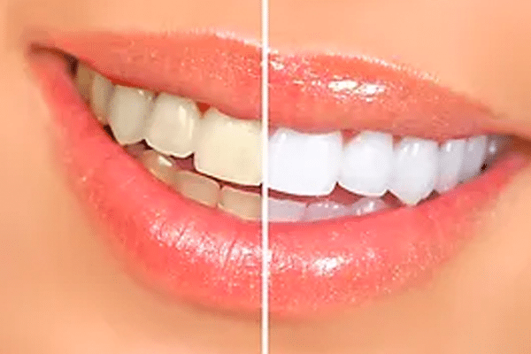 Carina Teeth Whitening Services